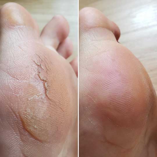 SoleGlow™ Pro Callus Remover