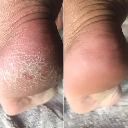 SoleGlow™ Pro Callus Remover