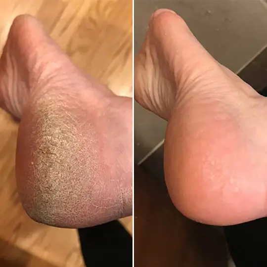 SoleGlow™ Pro Callus Remover